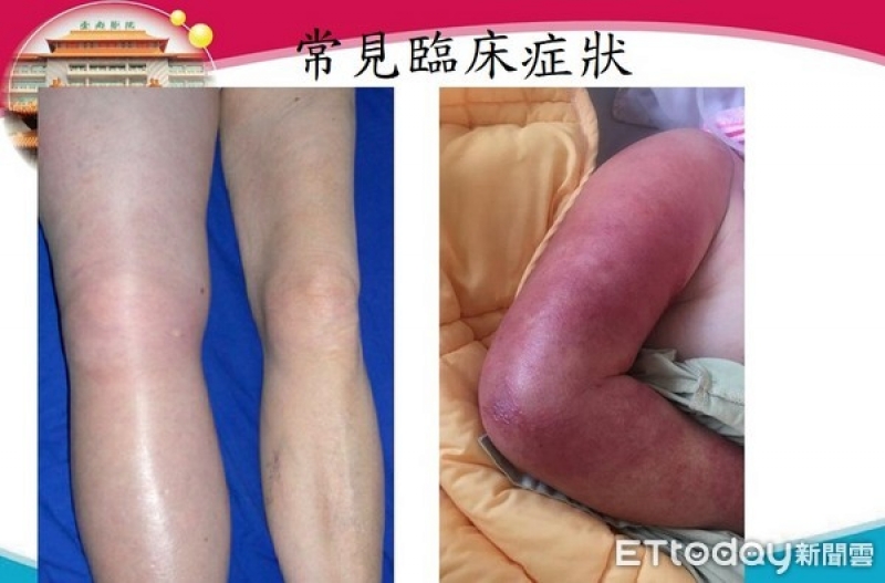 深層靜脈栓塞，常見的臨床表現多為單側的肢體（或不對稱）逐漸性腫脹、酸麻、觸痛、疼痛等