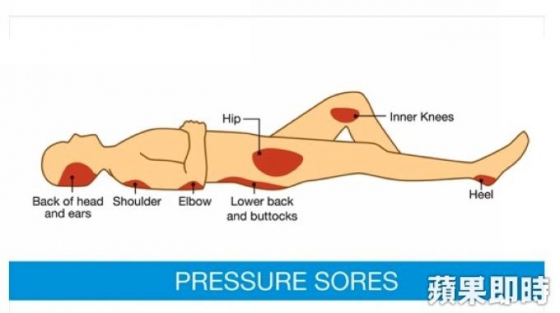 久坐輪椅褥瘡開花　他高燒39℃屁股險爛