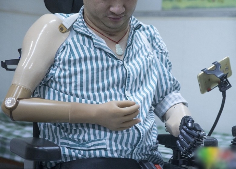 刘先生的右臂已能安装传统义肢