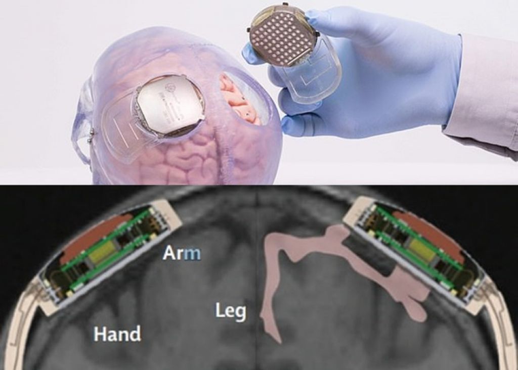 感應器安裝在顱骨及大腦之間