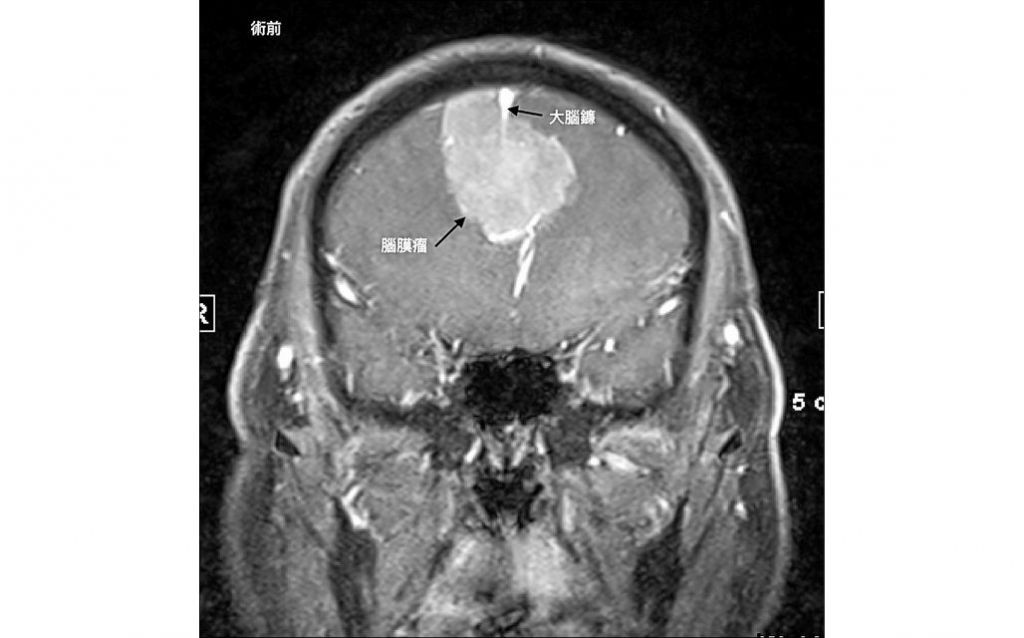 神秘微笑非中邪 6cm「大脑镰肿瘤」作祟