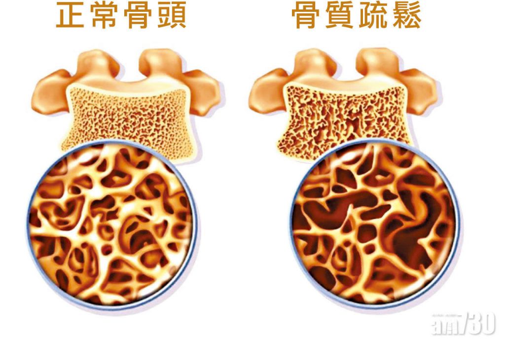 类风湿性关节炎破坏关节 严重或须轮椅代步