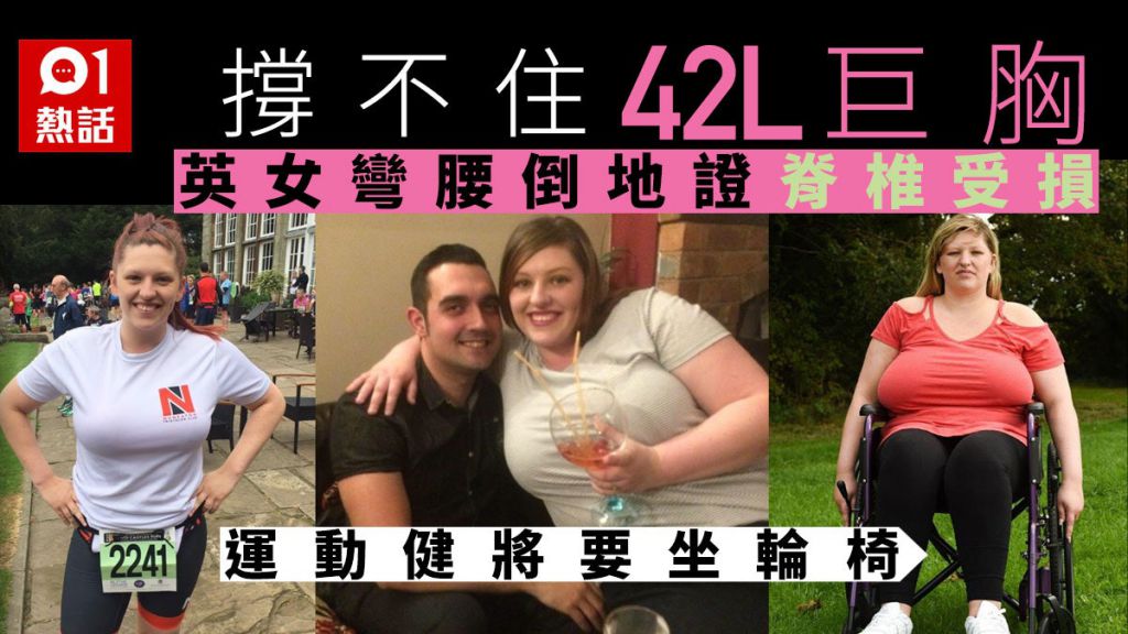 拥42L巨胸苦不堪言　脊椎剧痛须坐轮椅　英女众筹盼早日缩胸