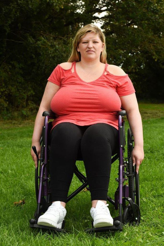 擁42L巨胸苦不堪言　脊椎劇痛須坐輪椅　英女眾籌盼早日縮胸
