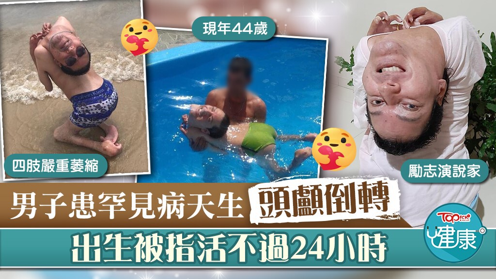 【顛倒人生】男子患罕見病天生頭顱倒轉　衝破活不過24小時命運成勵志演說家