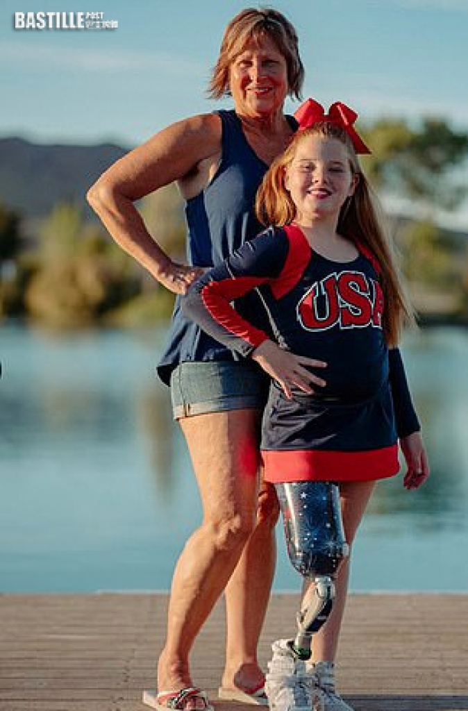 11歲罕見病女戴義肢跳躍翻騰 目標成殘奧啦啦隊成員