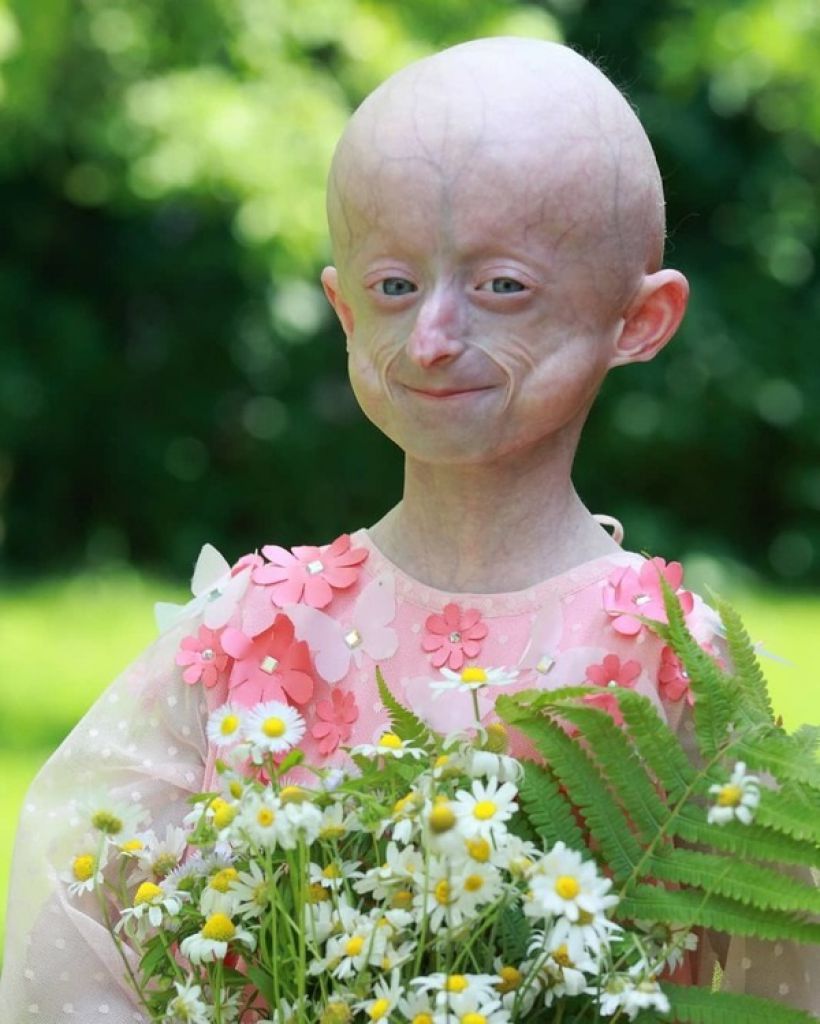 烏克蘭一名10歲女童 lryna Khimich 因罹患罕見病，擁有一副80歲身體。