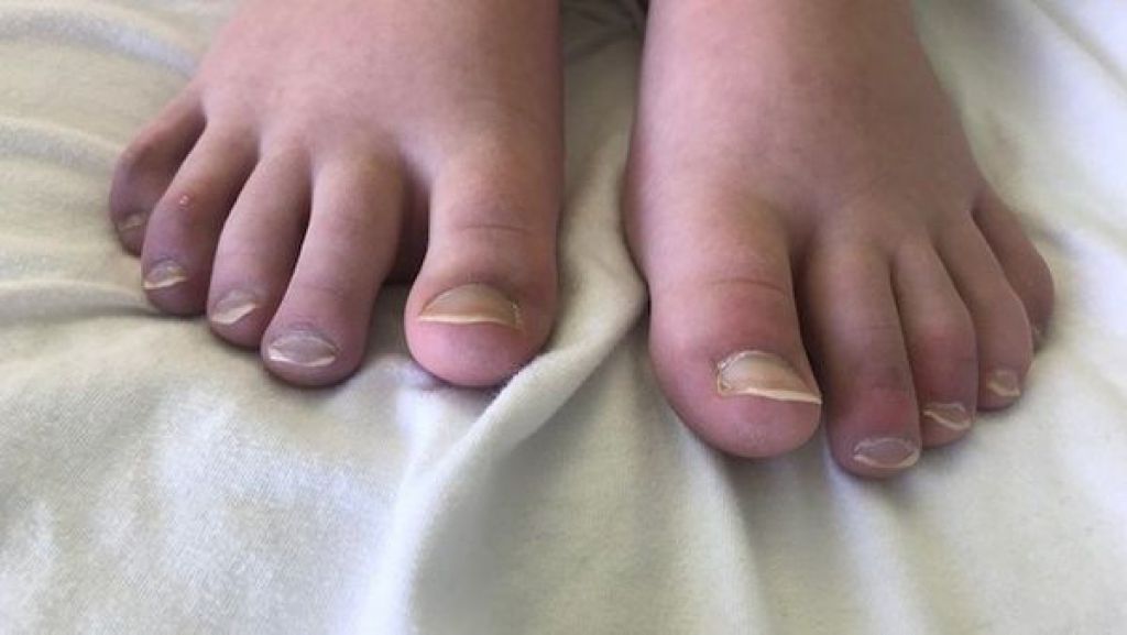 新冠肺炎｜13歲女腳趾浮腫發紫9個月要坐輪椅 患「新冠腳趾」檢驗卻呈陰性｜附醫生拆解