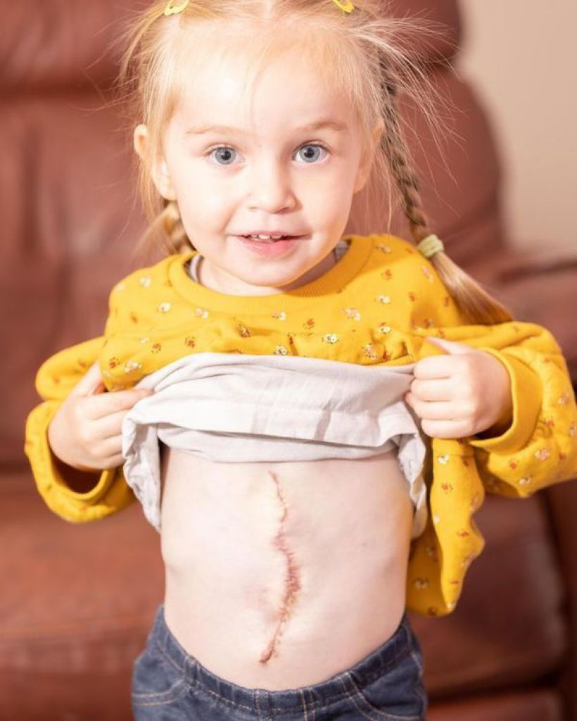 手术在她的腹部留下很长的疤痕。