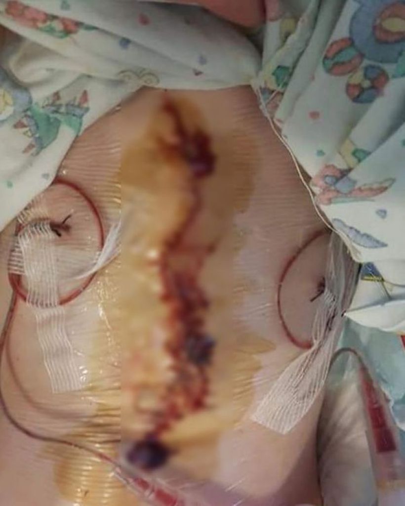 3岁后，Laurel接受手术把器官移入体内。