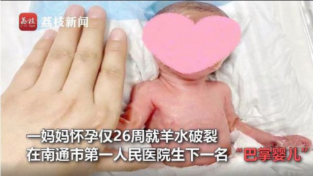 26周早產嬰僅手掌般大 奮鬥2個月終健康出院與家人團聚