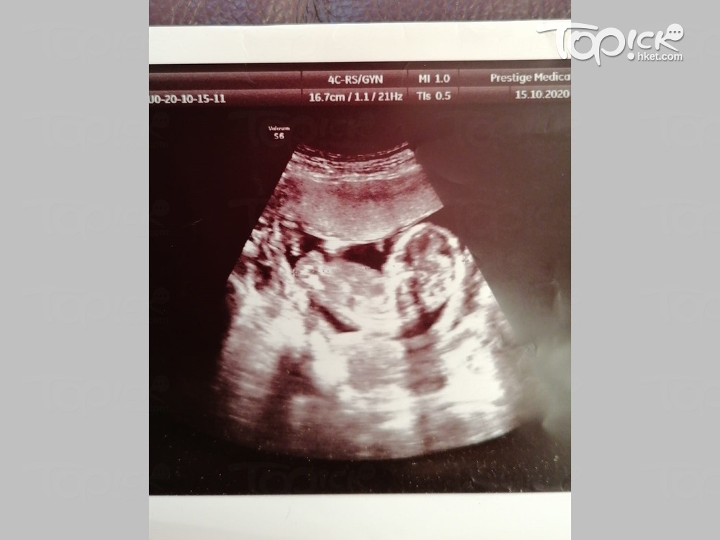 醫生在22周產檢告知，胎兒有T13巴陶氏症。